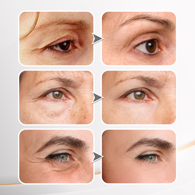 (🎄Christmas Event-50%off🎁)Instant Wrinkle Eye Tightener cream✨
